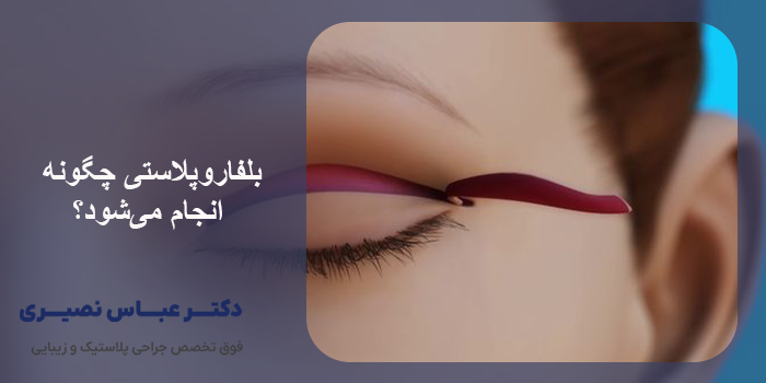 عوارض احتمالی بلفاروپلاستی