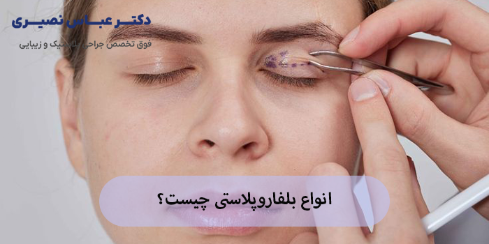 انواع بلفاروپلاستی
