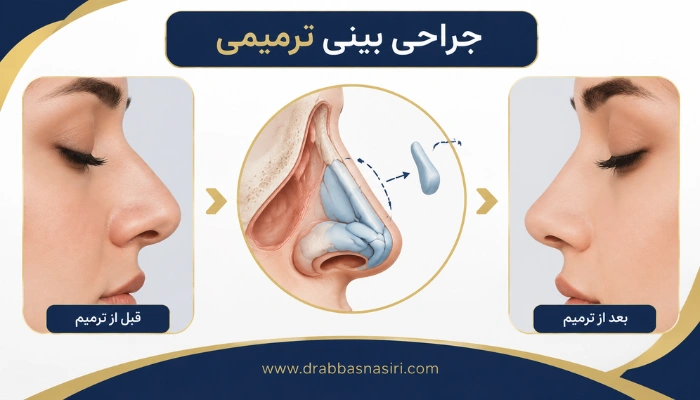 جراحی بینی ترمیمی و بازسازی ساختار بینی بعد از عمل قبلی
