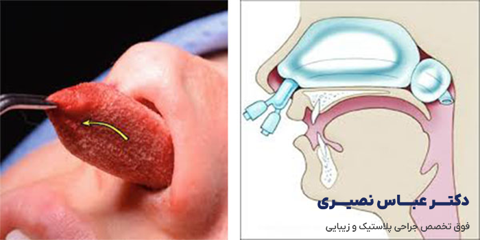 تامپون بعد از عمل بینی