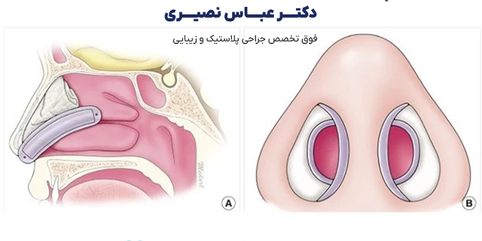 تامپون بعد از عمل بینی