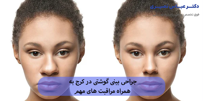 جراحی بینی گوشتی در کرج به همراه مراقبت های مهم