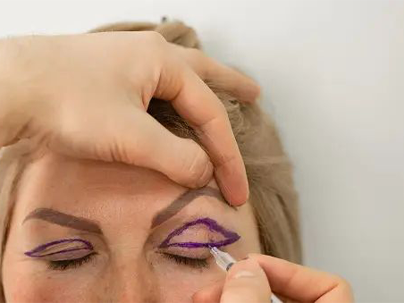 هزینه بلفاروپلاستی