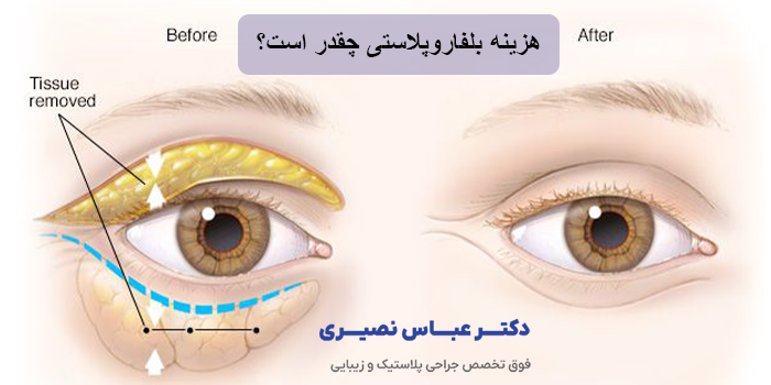 هزینه بلفاروپلاستی در سال 1404 در کرج