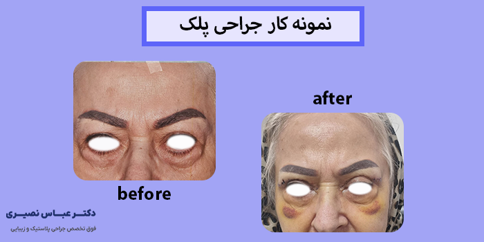 نمونه کار جراحی پلک