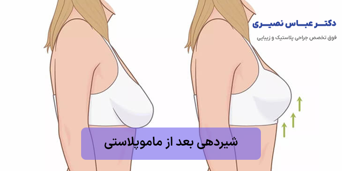 شیردهی بعد از ماموپلاستی