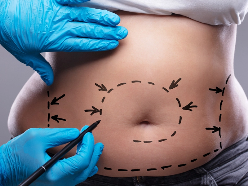بهترین دکتر ابدومینوپلاستی
