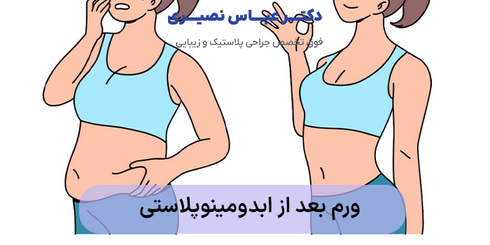 ورم بعد از ابدومینوپلاستی