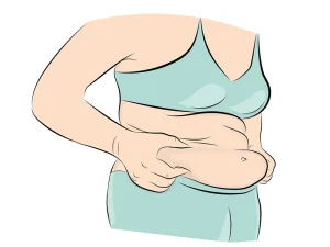 عفونت ناف بعد از ابدومینوپلاستی