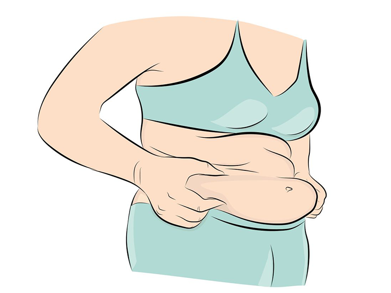 عفونت ناف بعد از ابدومینوپلاستی