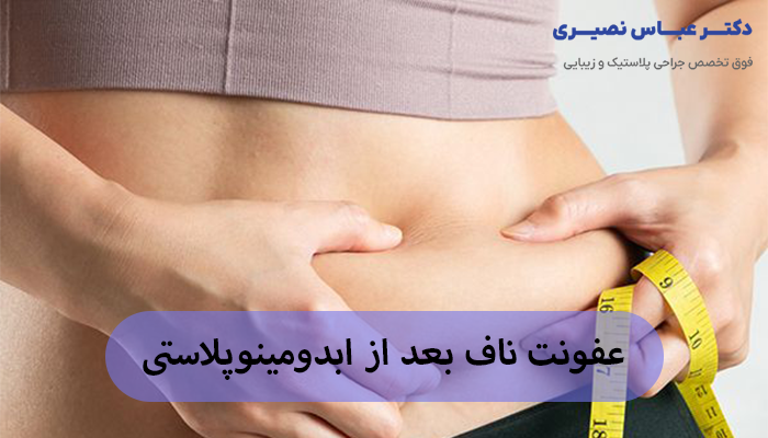 عفونت ناف بعد از ابدومینوپلاستی
