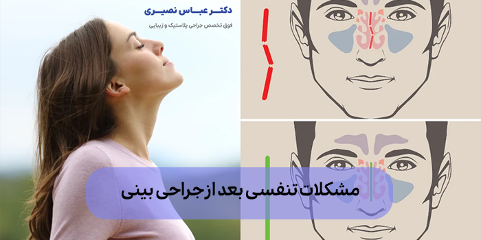 راهکارهای کاهش مشکلات تنفسی بعد از عمل بینی