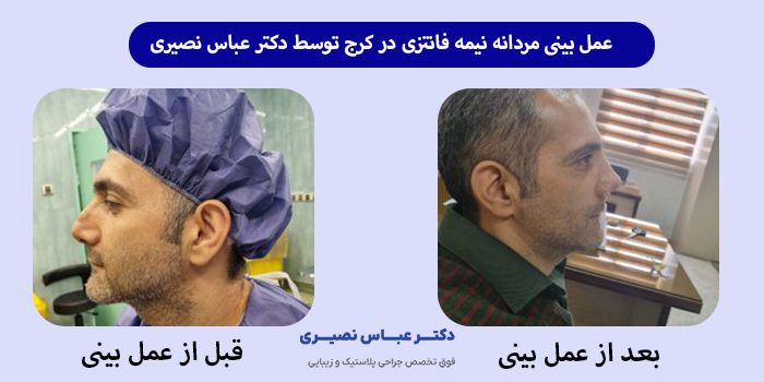 عمل بینی نیمه فانتزی مردانه