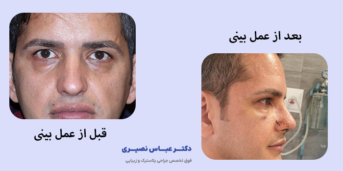 عمل بینی مردانه در کرج