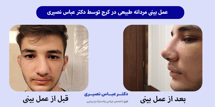 عمل بینی مردانه طبیعی در کرج