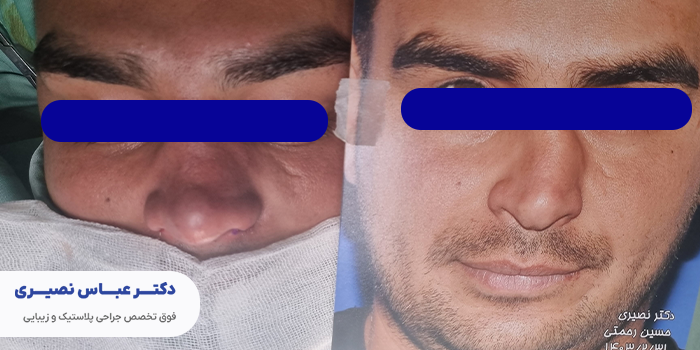 بهترین سن برای عمل بینی مردانه