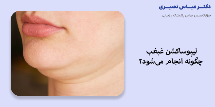 لیپوساکشن غبغب در کرج