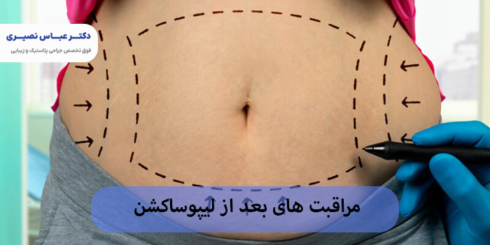 مراقبت های بعد از لیپوساکشن