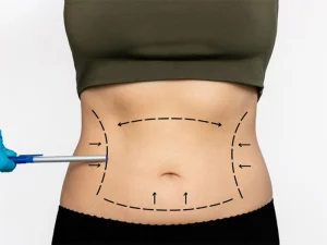 لیپوساکشن شکم