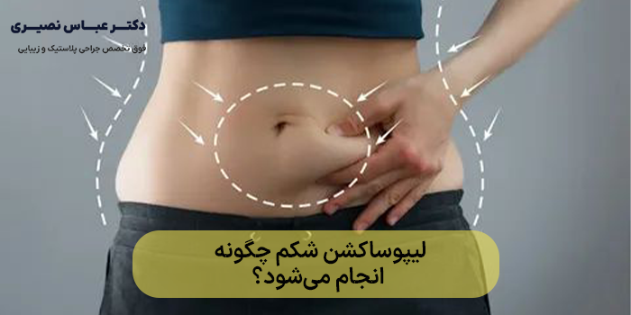 لیپوساکشن شکم