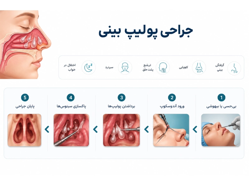 عمل پولیپ بینی در کرج