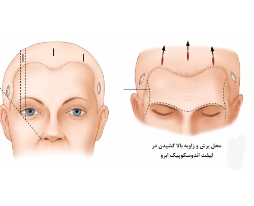 لیفت اندوسکوپیک ابرو