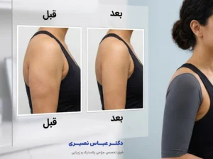 لیپو بازو