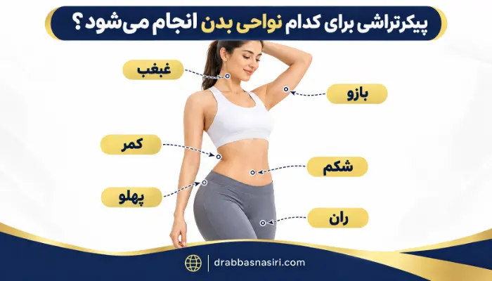 نواحی قابل پیکرتراشی شامل شکم، پهلو، ران، بازو، کمر و غبغب