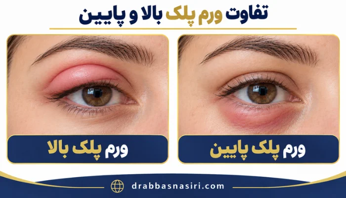 مقایسه ورم پلک بالا و پایین بعد از بلفاروپلاستی